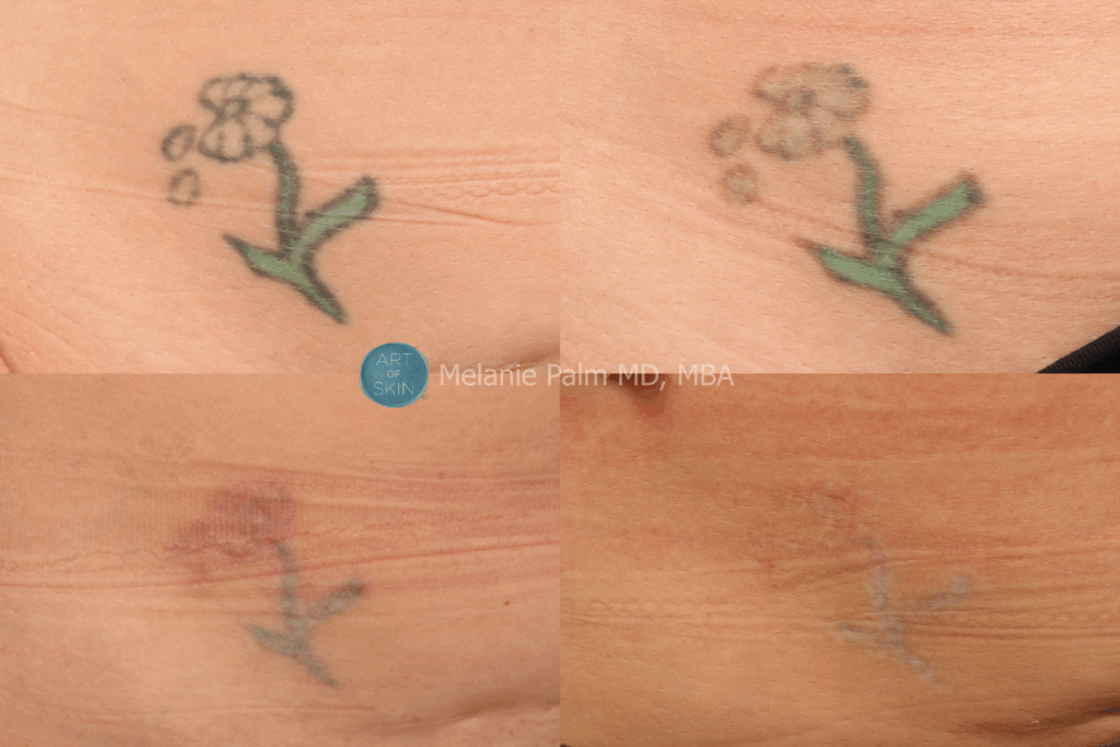 Art of Skin md Spectra tattoo removal before and after