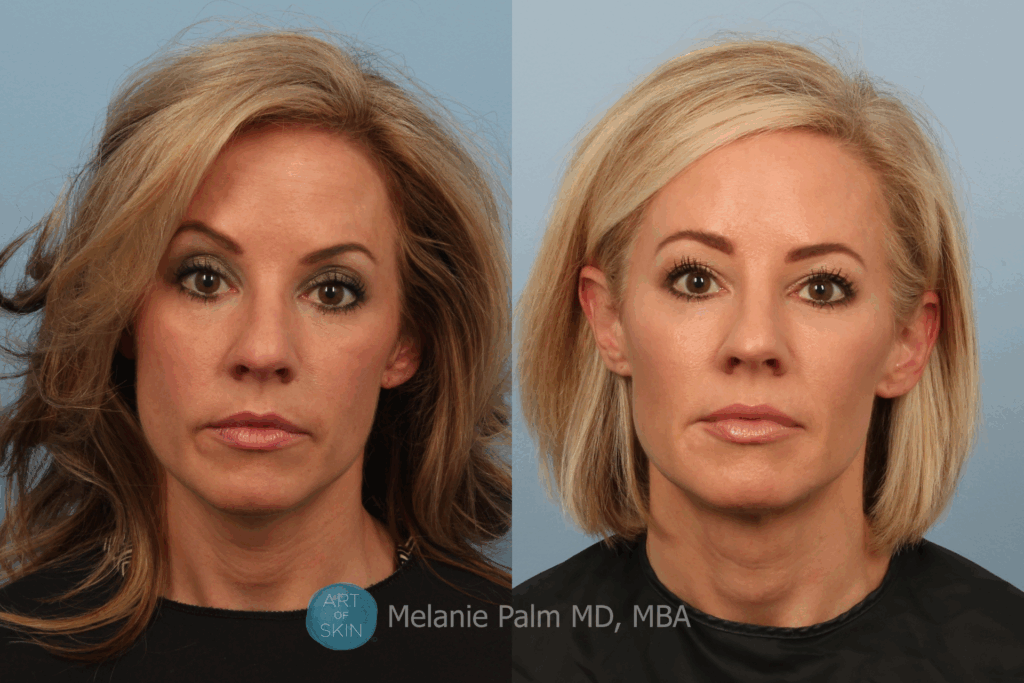 art of skin md Before and after facial rejuvenation volbella lips
