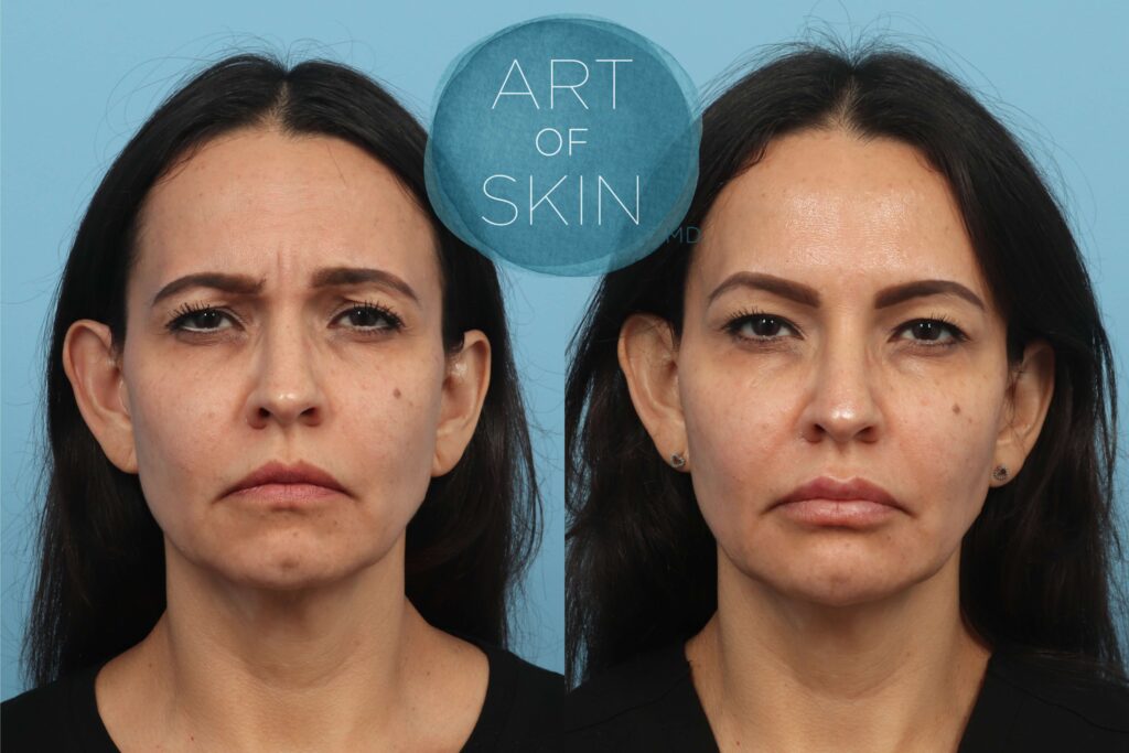 art of skin md san diego botox before and after glabella