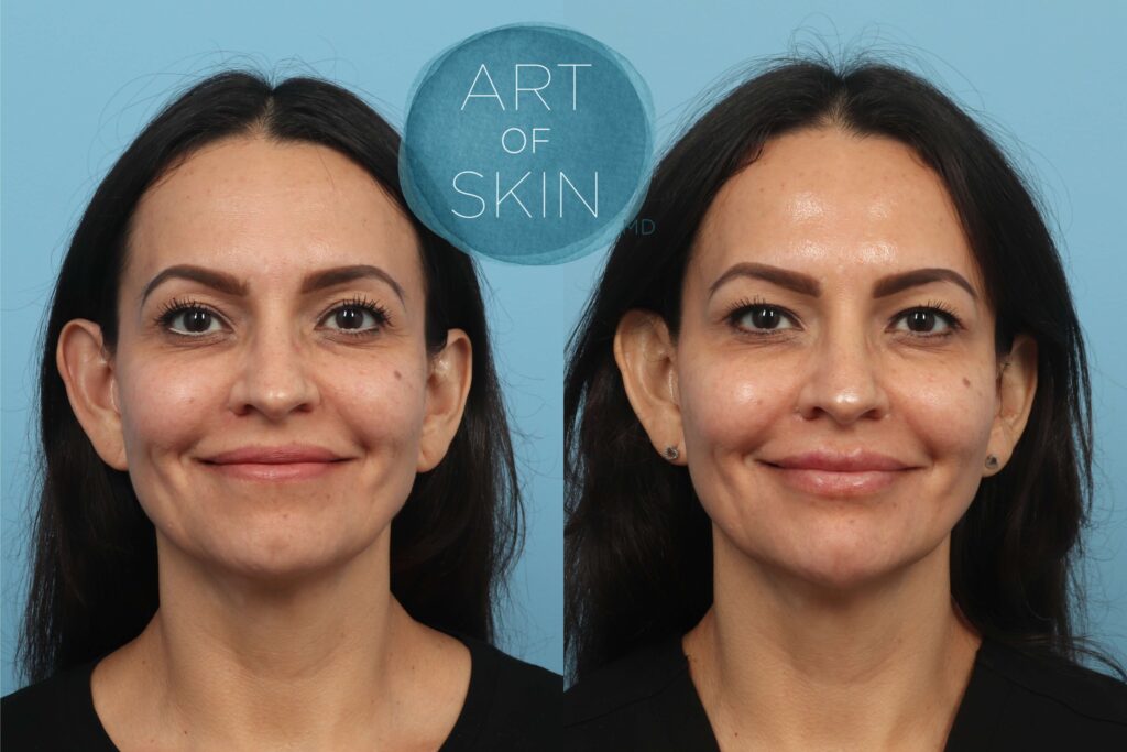 art of skin md san diego botox before and after crows feet