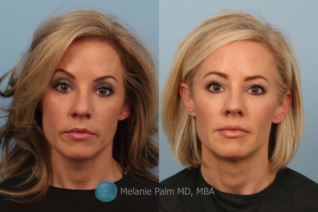 dr melanie palm san diego botox before and after upper face