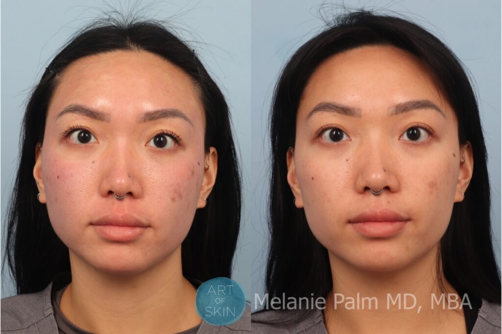 art of skin md voluderm microneedling acne scarring before and after