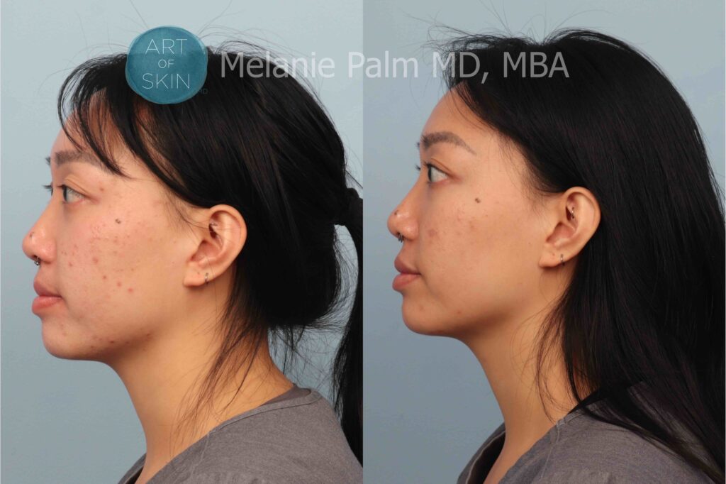 art of skin md voluderm microneedling acne scarring before and after