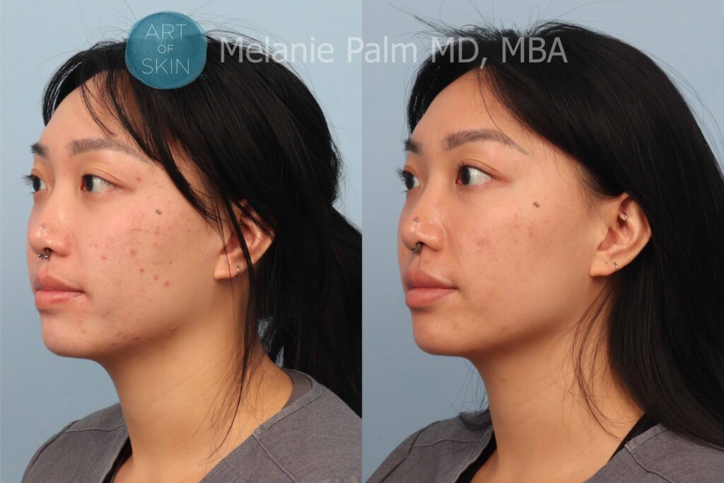 art of skin md voluderm microneedling acne scarring before and after
