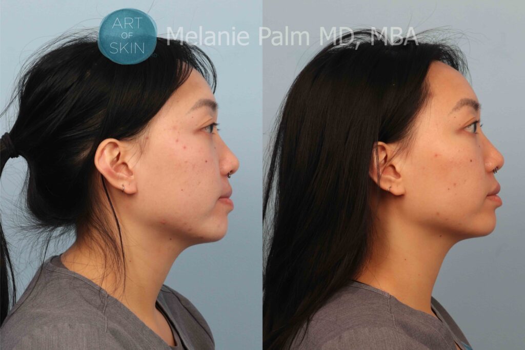 art of skin md voluderm microneedling acne scarring before and after