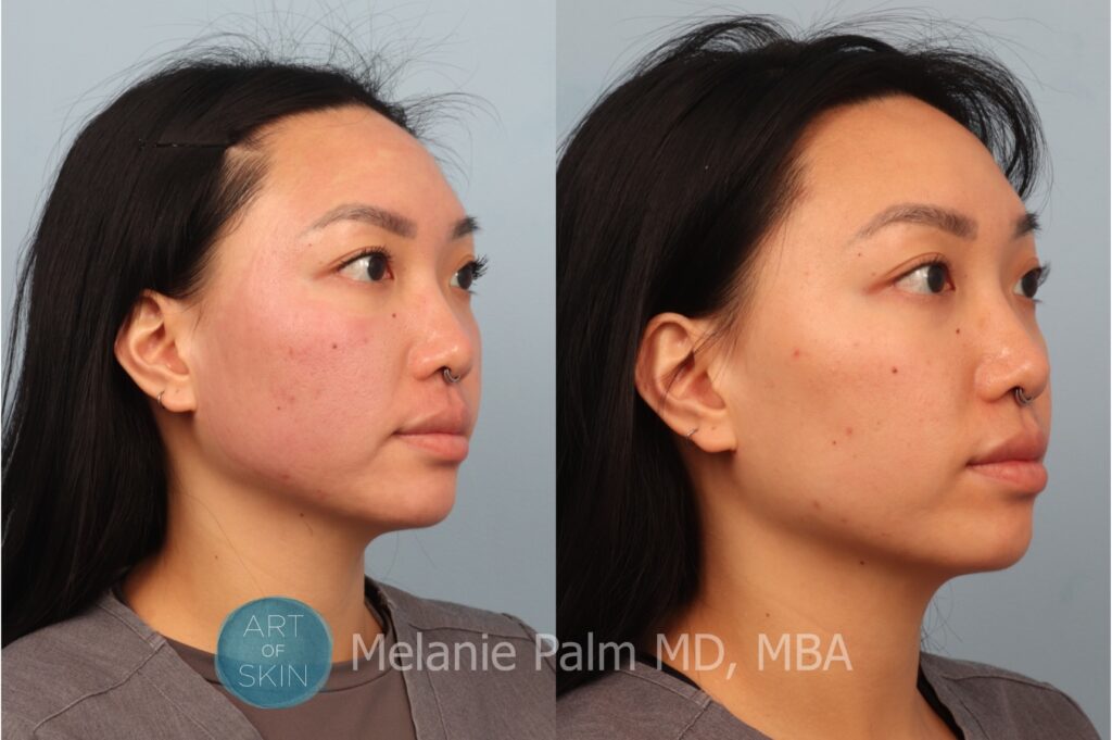 art of skin md voluderm microneedling acne scarring before and after