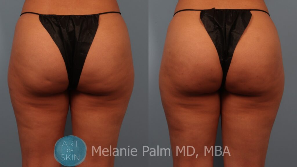 cellfina to buttocks before and after art of skin md