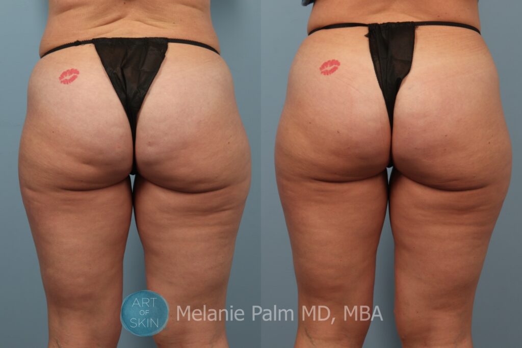 cellfinw to buttocks before and after art of skin md