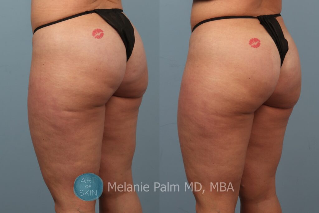 cellfina to buttocks before and after art of skin md