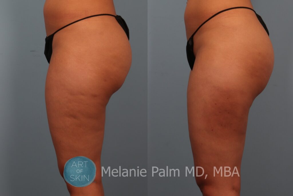 cellfina to buttocks before and after art of skin md