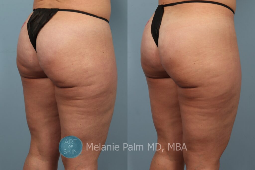 cellfina to buttocks before and after art of skin md