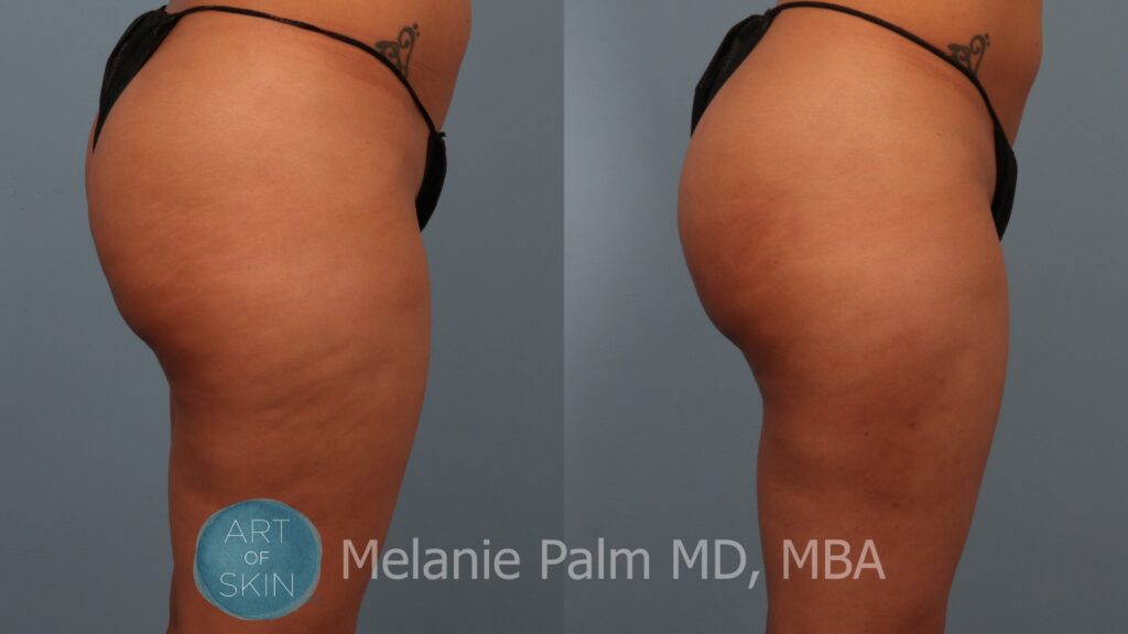 cellfina to buttocks before and after art of skin md