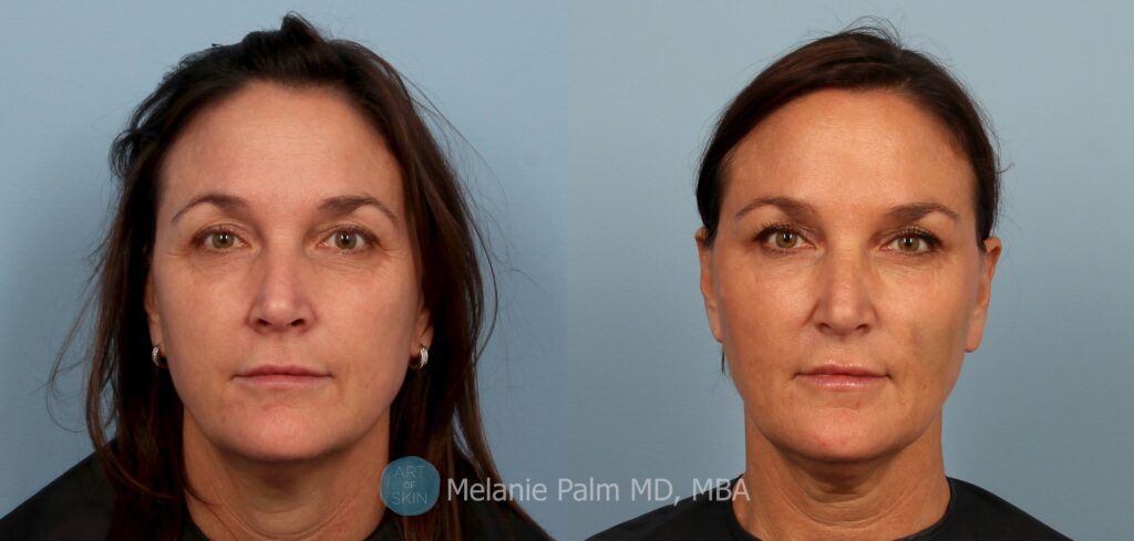 art of skin md instalift non surgical facelift
