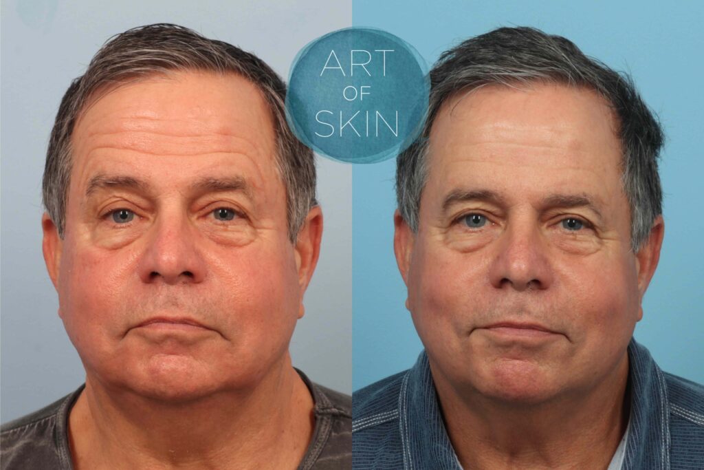 art of skin md resurfx face before and after