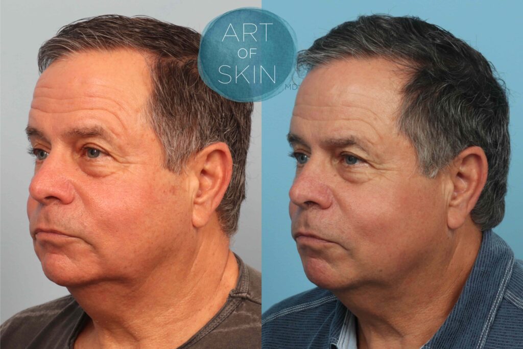 art of skin md resurfx face before and after