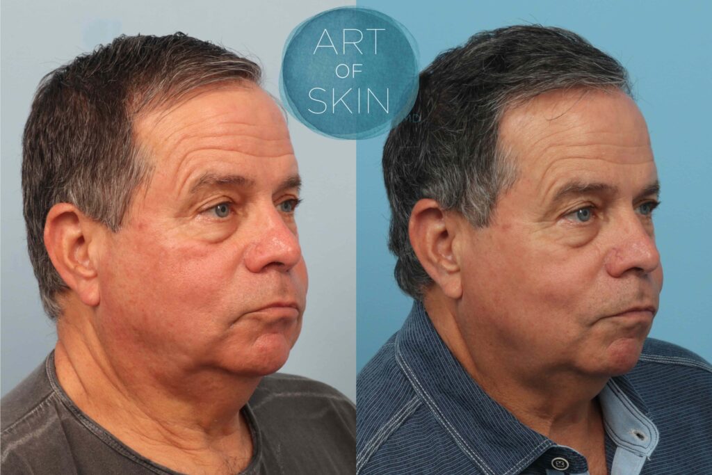 art of skin md resurfx face before and after