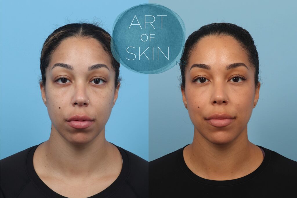 art of skin md before and after Ezgel PRF under eyes