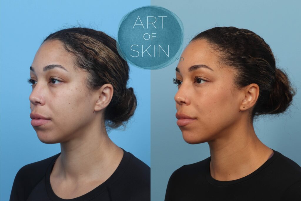 art of skin md before and after Ezgel PRF under eyes