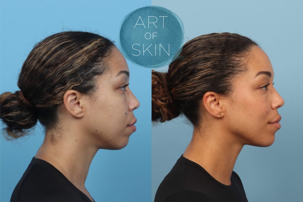 art of skin md before and after Ezgel PRF under eyes