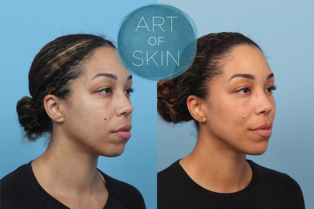 art of skin md before and after Ezgel PRF under eyes