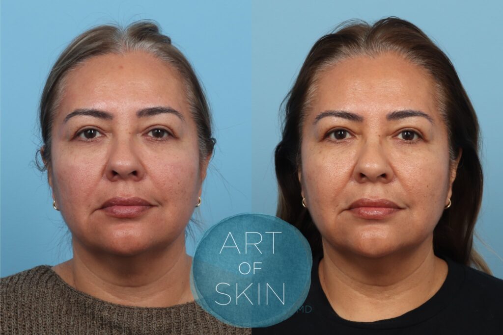 art of skin md before and after VI Peel