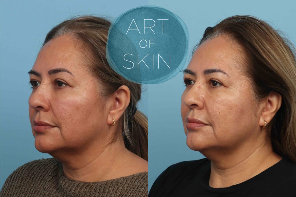 art of skin md before and after VI Peel