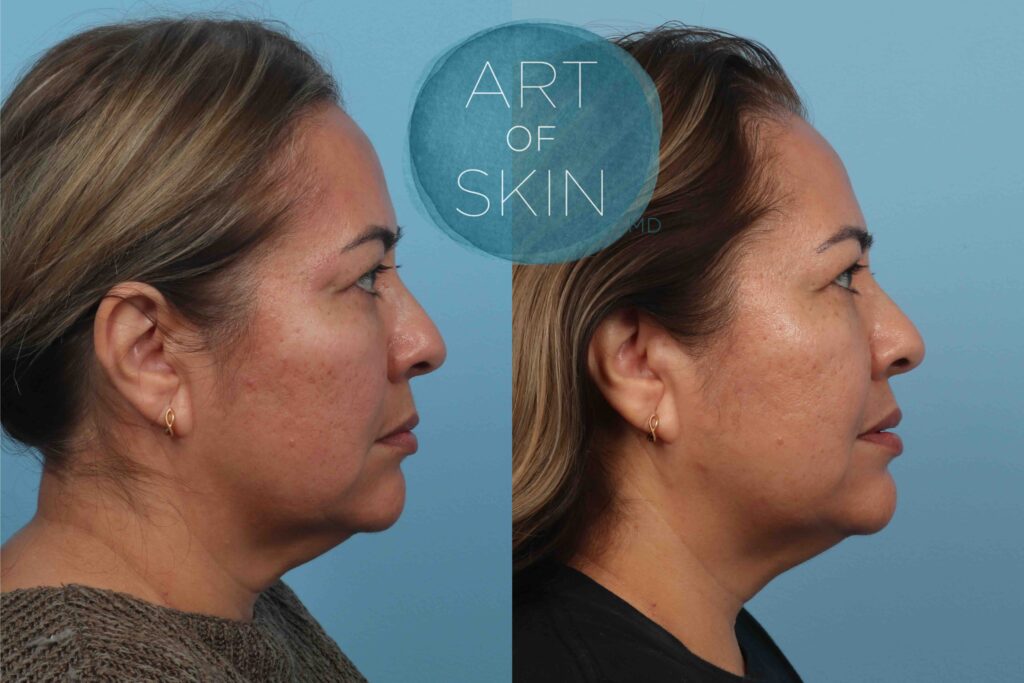 art of skin md before and after VI Peel