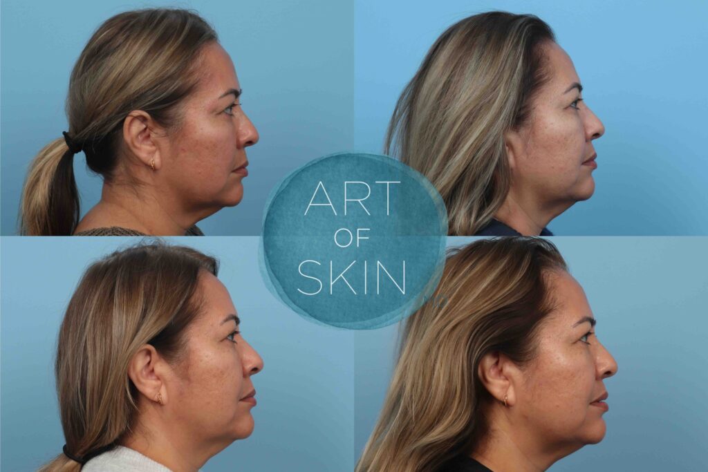 art of skin md before and after VI Peel