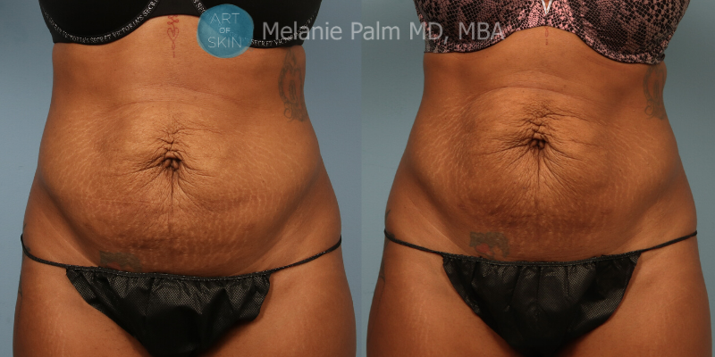 art of skin md emtone before and after abdomen front
