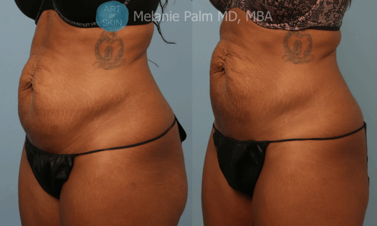 art of skin md emtone before and after abdomen front