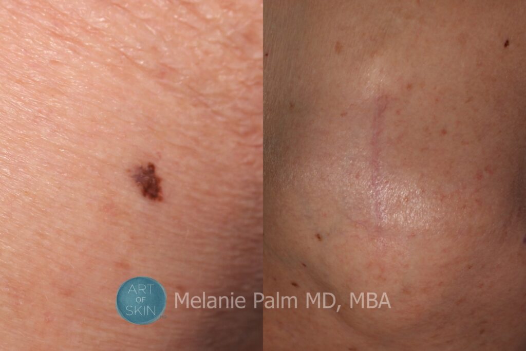art of skin md before and after melanoma and mole removal
