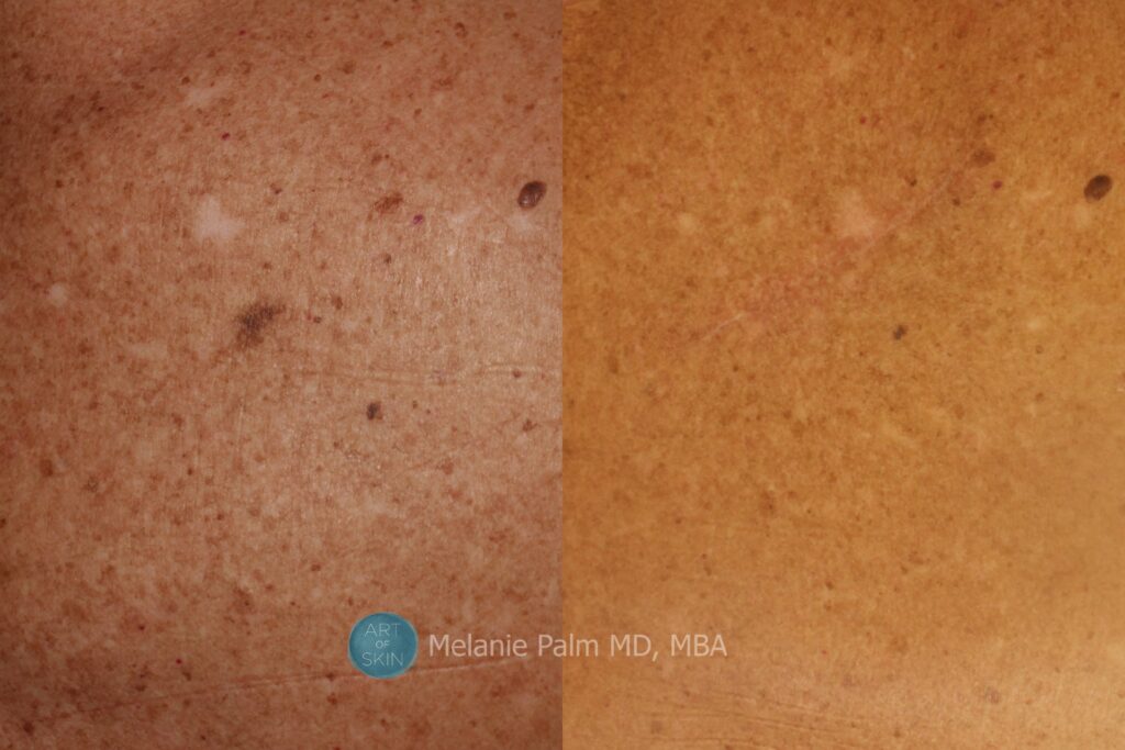 art of skin md before and after melanoma and mole removal