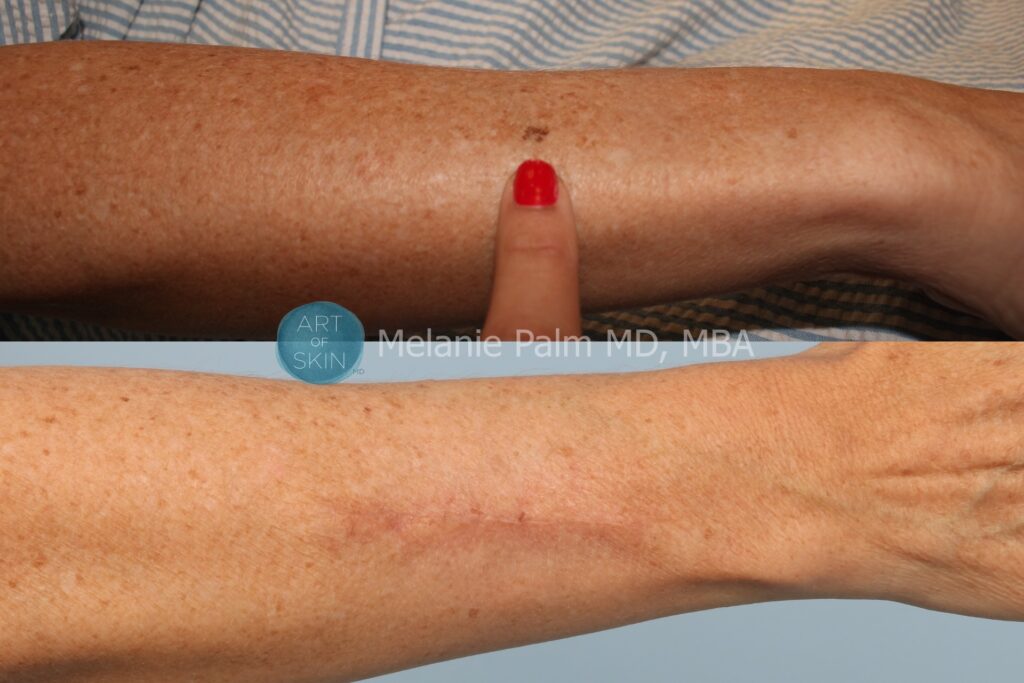 art of skin md before and after melanoma and mole removal