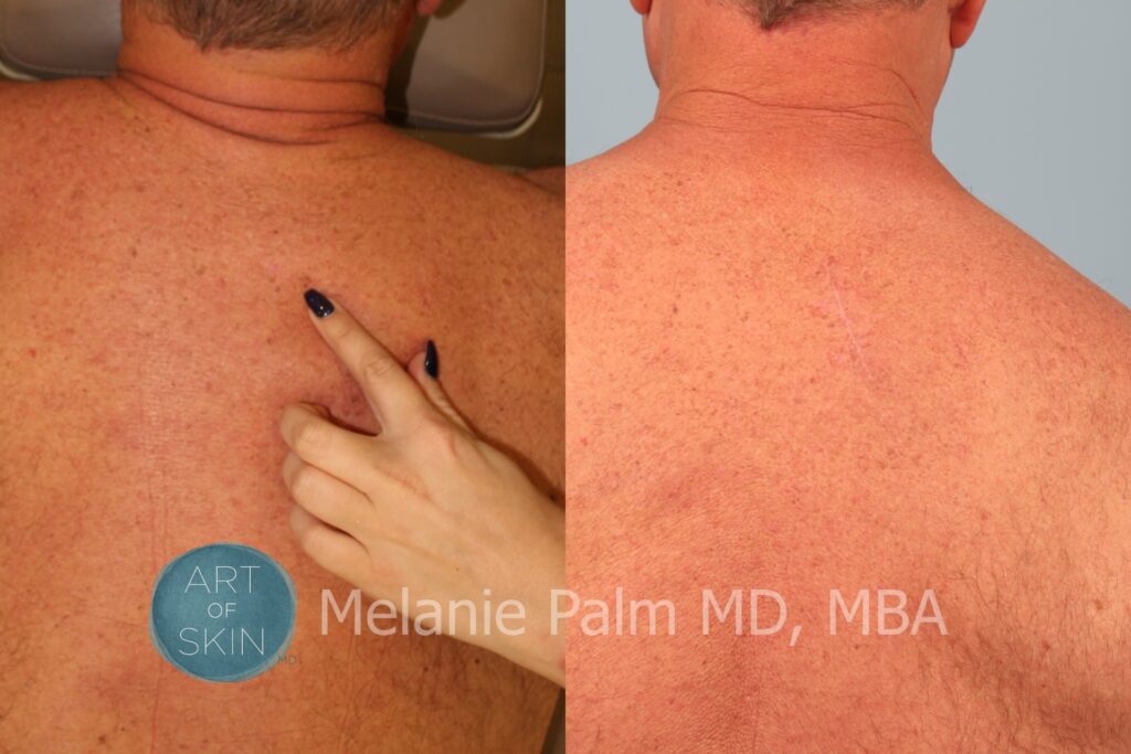 art of skin md before and after melanoma and mole removal