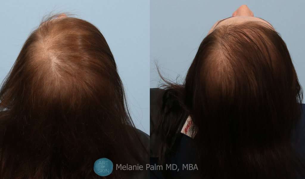art of skin md prp for hair loss before and afters