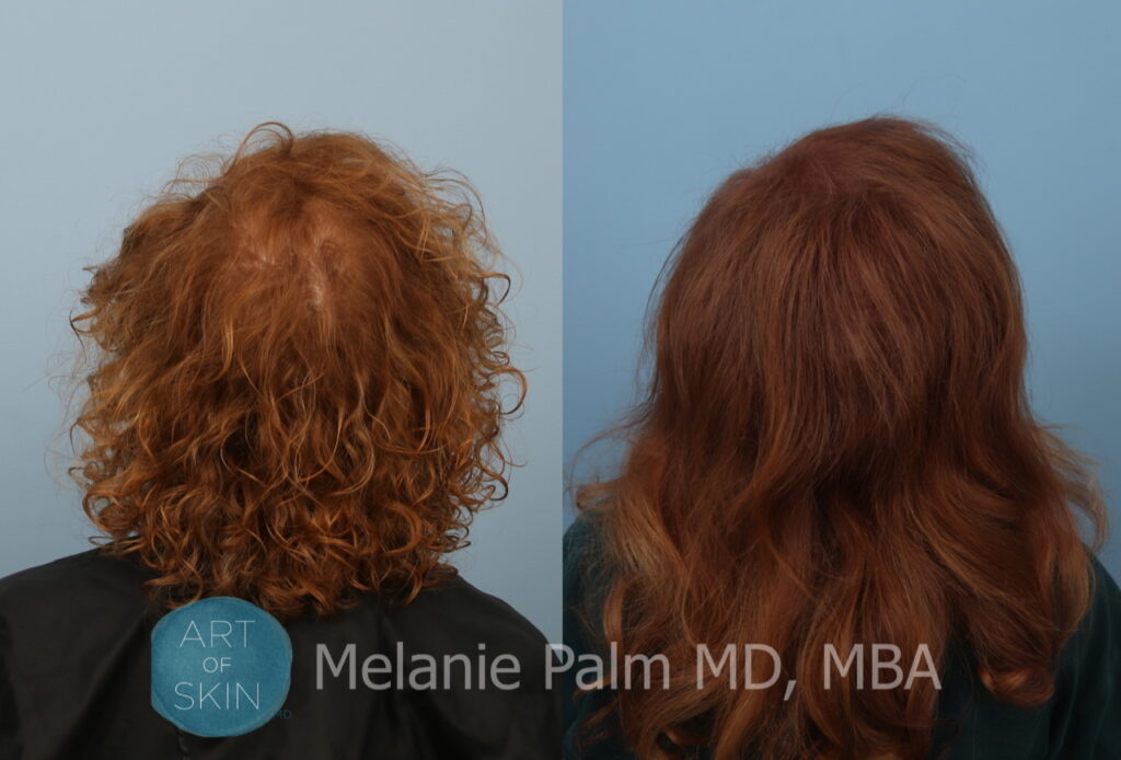 art of skin md prp for hair loss before and afters