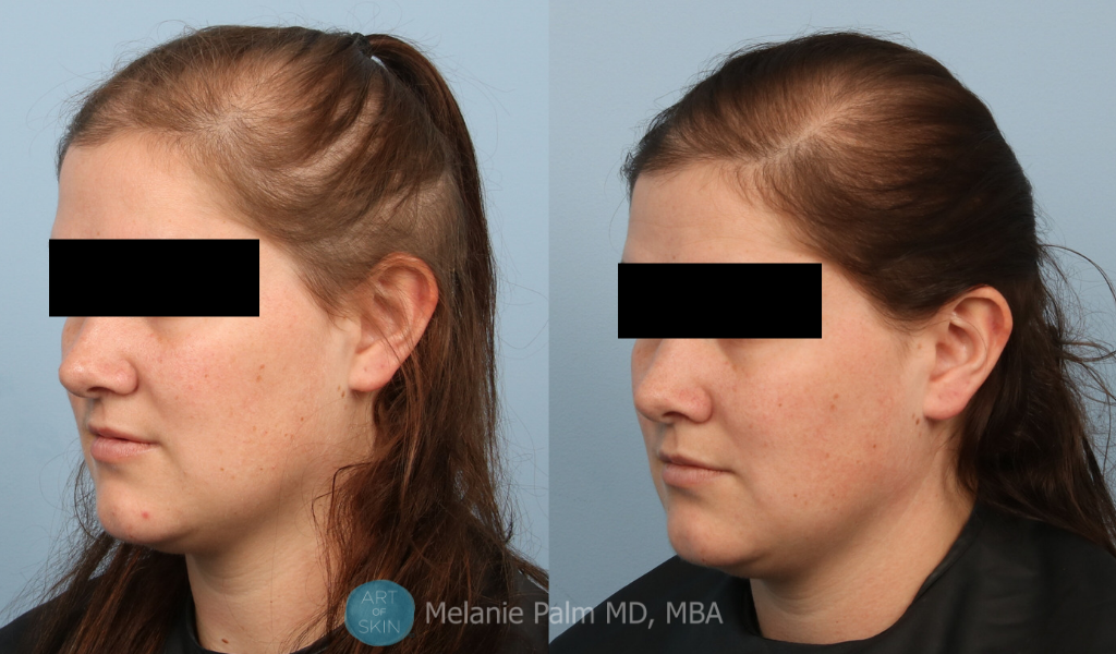 art of skin md prp for hair loss before and afters