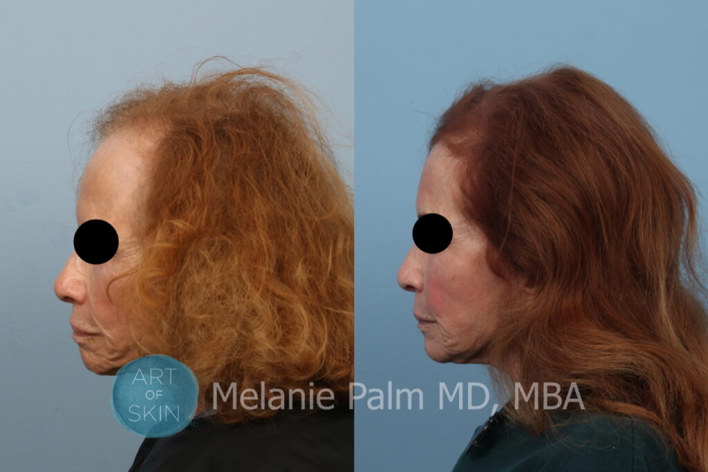 art of skin md prp for hair loss before and afters