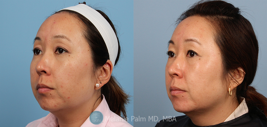 Spectra Nd:YAG Multipurpose Laser, Art of Skin MD