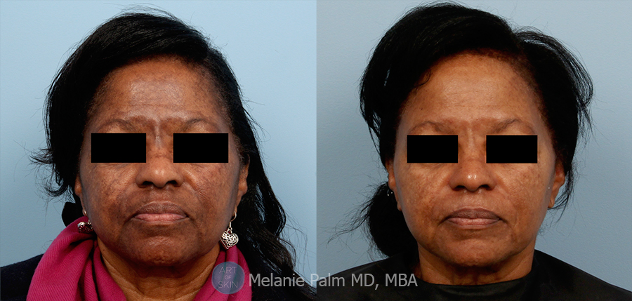 Spectra Nd:YAG Multipurpose Laser, Art of Skin MD