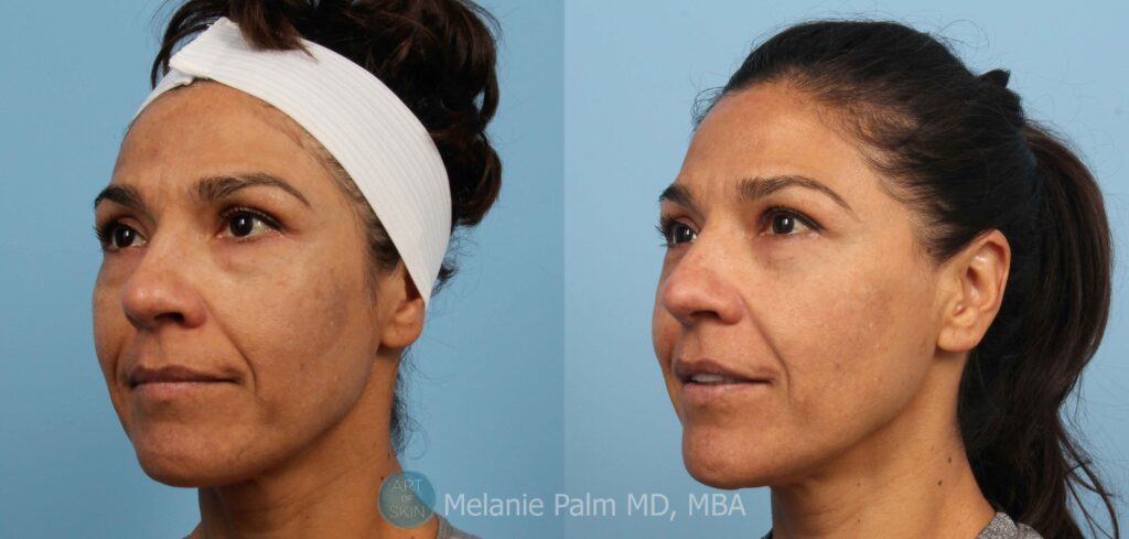 Spectra Nd:YAG Multipurpose Laser, Art of Skin MD