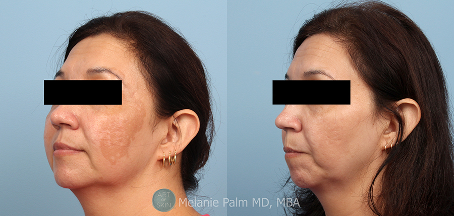 Spectra Nd:YAG Multipurpose Laser, Art of Skin MD