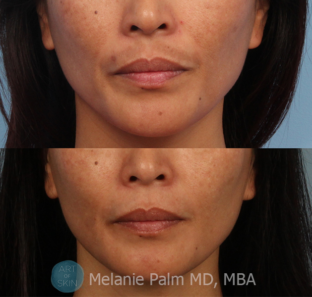 Spectra Nd:YAG Multipurpose Laser, Art of Skin MD