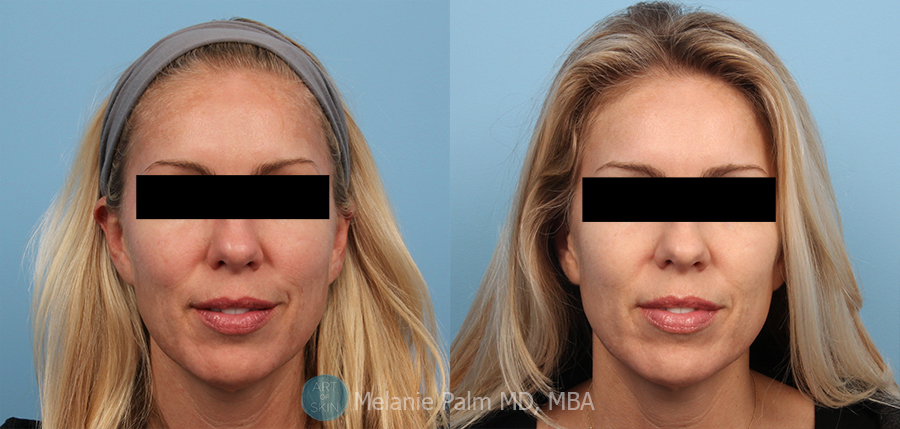 Spectra Nd:YAG Multipurpose Laser, Art of Skin MD