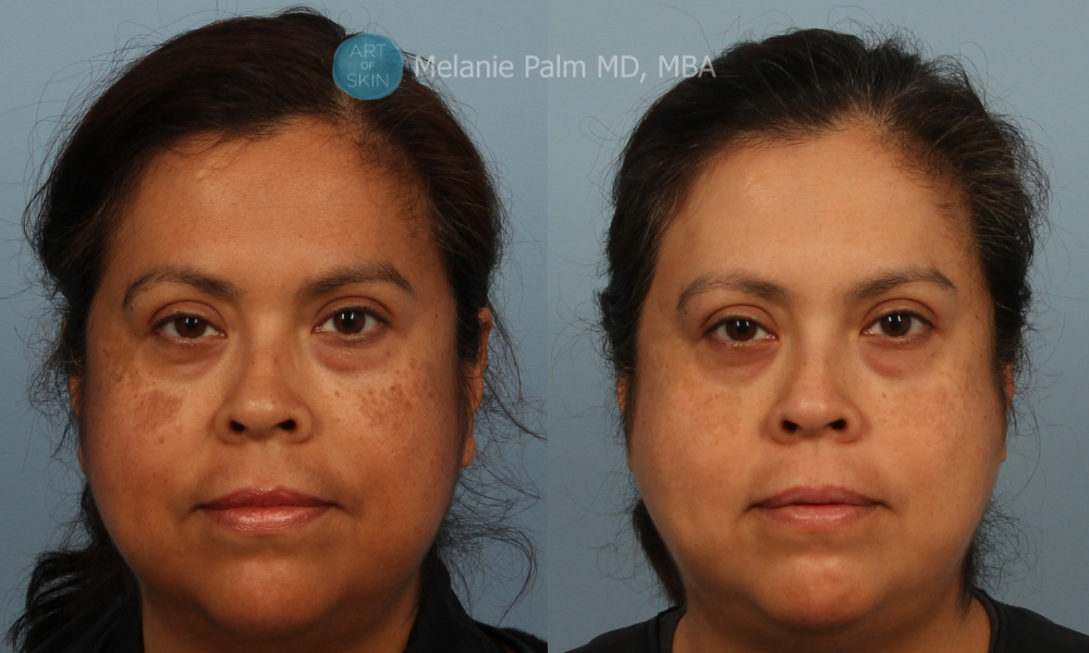 Spectra Nd:YAG Multipurpose Laser, Art of Skin MD