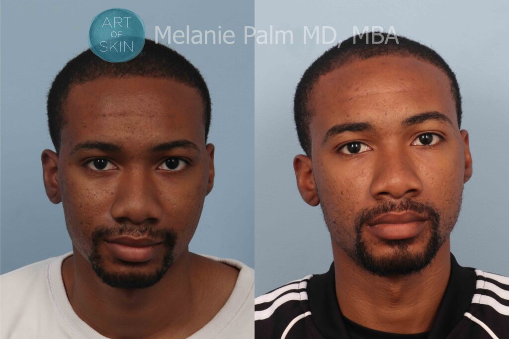 art of skin md voluderm microneedling acne scarring before and after
