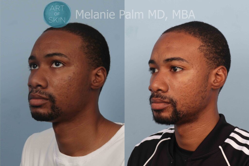 art of skin md voluderm microneedling acne scarring before and after