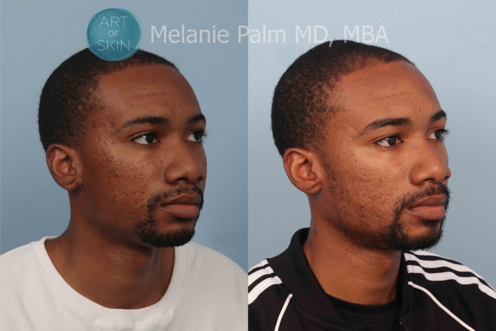 art of skin md voluderm microneedling acne scarring before and after
