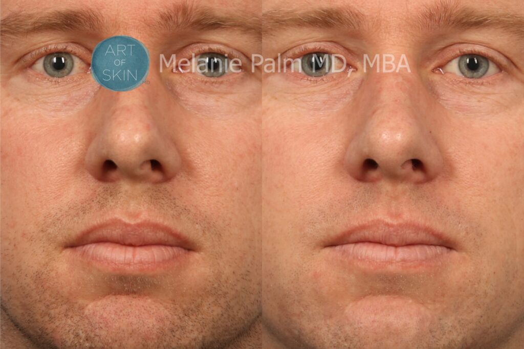 art of skin md before and after VI Peel