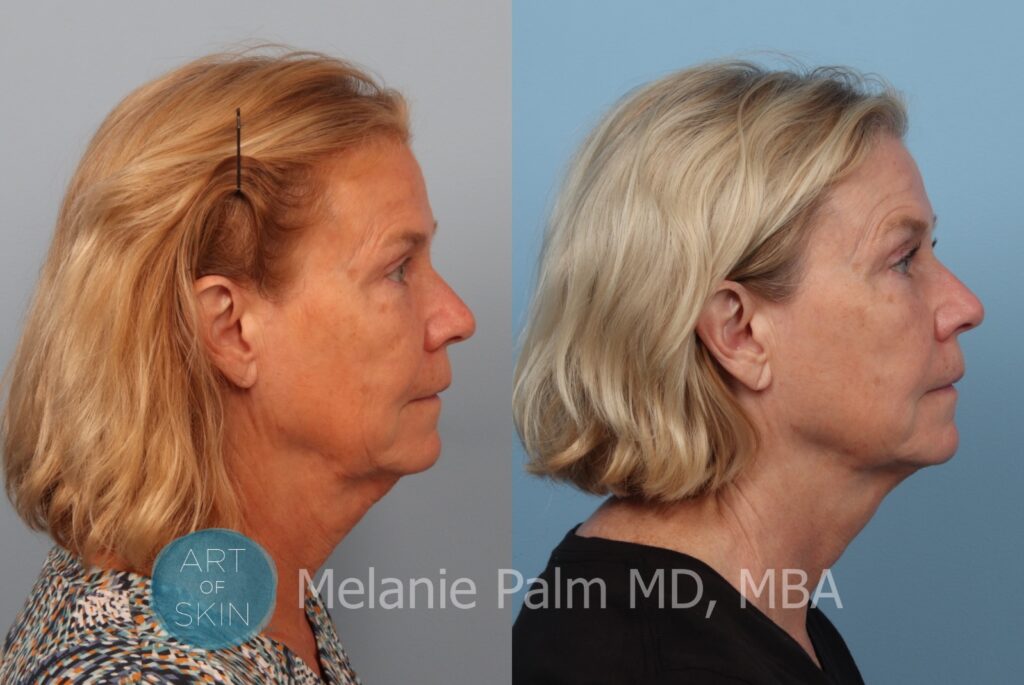 art of skin md instalift non surgical facelift result